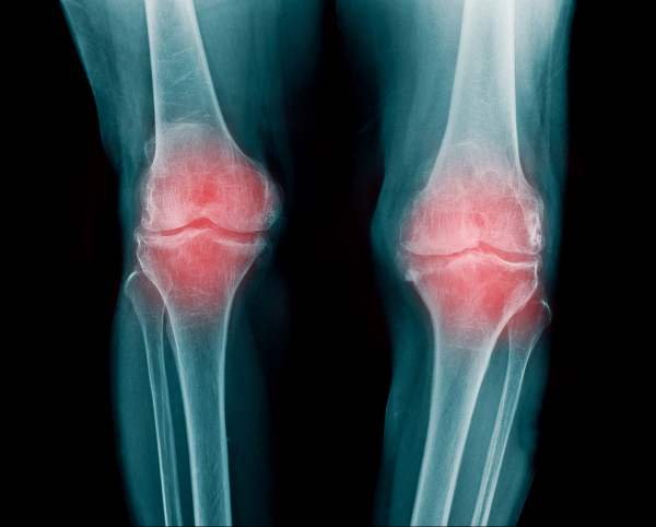 La membrana de cáscara de huevo reduce las molestias de la artrosis de rodilla, comprobado en un estudio a gran escala